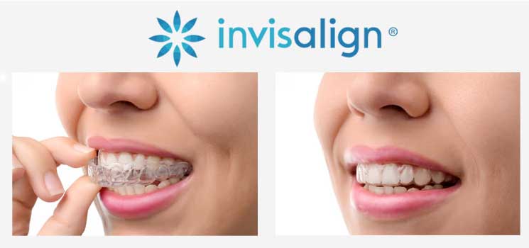invisalign-two-steps